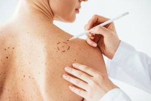 Quais os sintomas de câncer de pele e como evitá-lo