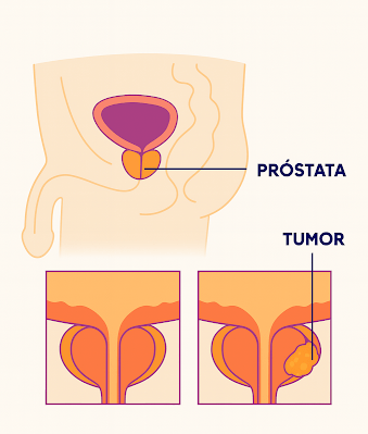 Representação visual câncer de próstata